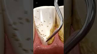 Plaque removal from teeth Waterpick method of plaque removal Teeth teethcleaning [upl. by Anyzratak]