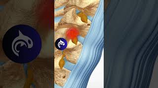 Cervical Selective Nerve Root Block SNRB anatomy orthopedics spine [upl. by Aurelia574]