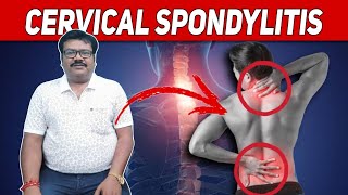 cervical spondylitis cervical painfyp [upl. by Godfree]