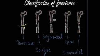 Classifying and presenting Fractures  Orthopaedics for Medical Students  Finals [upl. by Thatch]