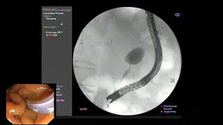 ERCP  EST with SEMS placement for mid CBD stricture from advance pancreatic cancer [upl. by Kuska634]