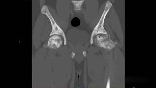 Avascular Necrosis of Femoral Head  Radiology Short Cases [upl. by Sirk]