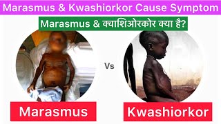 Marasmus and ￼￼ Kwashiorkor Cause Symptom Treatment  Marasmus  Kwashiorkor  Marasmus Kwashiorkor [upl. by Lehsreh]