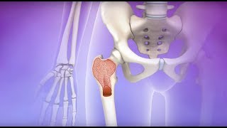 Myelofibrosis  Mayo Clinic [upl. by Assi]