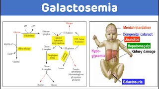 Galactosemia And Galactose Metabolism  Galactosemia Biochemistry [upl. by Retniw122]