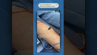 Electroacupuncture for heel pain A GameChanging Solution [upl. by Javed419]