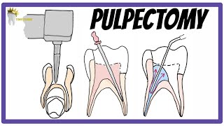 PULPECTOMY  Indications Contraindications Rationale obturation materials [upl. by Aicena]