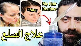 روتيني الخاص لعلاج الصلع الوراثي  لماذا لا استخدم المينوكسيديل 5 و نيو هير لوشن  Hair Care Routine [upl. by Enilada345]