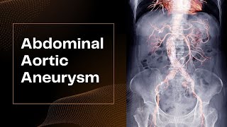 Abdominal Aortic Aneurysm [upl. by Eizdnil47]