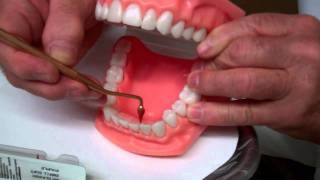 Rubber Tip Stimulator  Oral Hygiene Instructions by Dr Berdy periodontist Jacksonville FL [upl. by Ecnaralc]