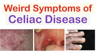 Weird Symptoms of Celiac Disease  Atypical Clinical Features [upl. by Barkley612]