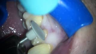 Refining margins for CEREC crown [upl. by Clellan]