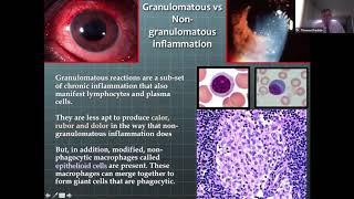 Lecture Granulomatous Disease in an Eye Practice [upl. by Ecirtnas]