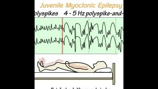 Epilepsia mioclónica juvenil o síndrome de Janz JME [upl. by Lavona]