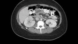 Radiology Rounds  A Radiologist Auntminnie CT scan of pyelonephritis [upl. by Esilehc]