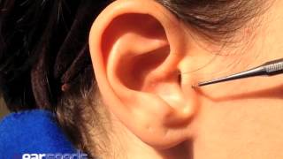 Tranquilizer Auriculotherapy Ear Point [upl. by Arraek]