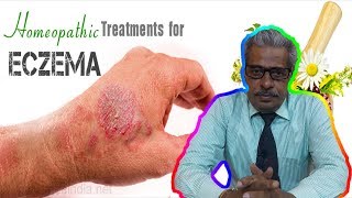 Eczema Dermatitis Treatment in Homeopathy by Dr PS Tiwari [upl. by Atteiram]