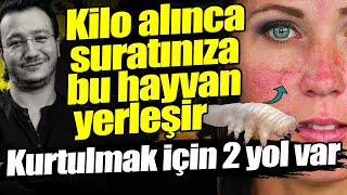 KİLO ALINCA SURARINIZA BU HAYVAN YERLEŞİR  Akne Rozasea Gül Hastalığı nedir [upl. by Couhp766]