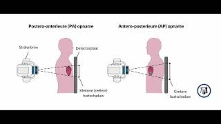 Why PA chest X ray views are preferred over AP views [upl. by Ermeena]