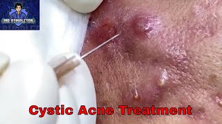 Cystic Acne Treatment  Cyst and Blackhead extraction  Pimple Popping  Clogged Pores [upl. by Hatokad]