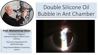 Double Silicone oil bubble in AC after complicated vitrectomy [upl. by Natsuj]