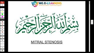 Mitral Stenosis  Cardiology  Davidson [upl. by Soalokcin513]