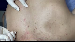 ACNE TREATMENT WITH VU QUYNH MI  Acne Squeeze on Back [upl. by Maitund560]