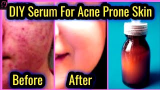 Serum For Acne Prone Sensitive Skin  Skin Care Routine For Oily Skin  Turmeric [upl. by Asena]