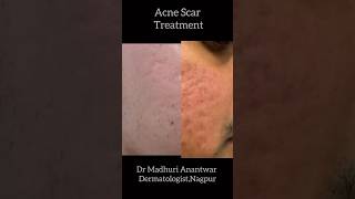 Acne scar laser treatment Dr Madhuri Anantwar Laser center Nagpur scarlaser [upl. by Tormoria527]