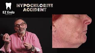 Hypochlorite Accident in Endodontics Part I حادثة خروج محلول الارواء اثناء تحضير قنوات الجذور [upl. by Ahsekahs]