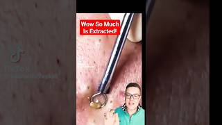 CRAZY LONG BLACKHEAD REMOVAL  Shocked shorts [upl. by Nosreh642]