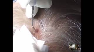 SCALP WARTSscalpdiseases CAUTERIZATIONREMOVALPROCEDUREbeforeafterresult DEEPLY ROOTED WART [upl. by Conlon]