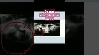 odontoameloblastomaoral pathologyameloblastic odontomaodontogenic tumor [upl. by Finn]