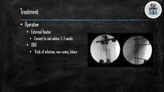 Femoral Shaft Fractures [upl. by Ehtyaf]