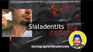 Sialadenitis [upl. by Eduj869]