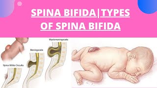 What Is Spina BifidaTypes Of Spina BifidaCauses Of Spina BifidaSpina Bifida [upl. by Geldens278]