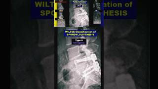 Spondylolisthesis  Wiltse Classification radiology bones spine xray [upl. by Yelsew]