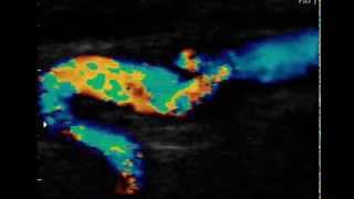 INTERNAL CAROTID ARTERY DISSECTION [upl. by Ayote]