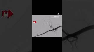 PAINFUL GROWING SWELLING ARTERIOVENOUS MALFORMATION TREATMENT BY embolization PINHOLE PROCEDURE [upl. by Begga352]