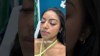 Stunning Lip Filler Transformation  Before amp After with Dr Dahabra in Florida shorts [upl. by Fatimah]