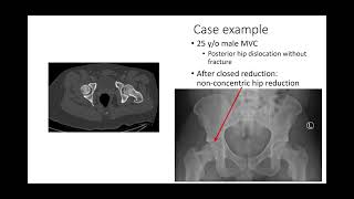 Hip dislocations and femoral head fractures  2 of 3 CCv5 [upl. by Latoye60]