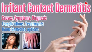 Irritant contact dermatitis overview causes symptoms treatment options and home remedies [upl. by Gianina]