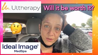 Ultherapy idealimage vlogday Vlog DayMy experience with Ultherapy and Ideal Image [upl. by Kilbride]