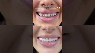 Invisalign and composite bonding by Dr Sonnie 🙌 compositebonding [upl. by Octavian749]