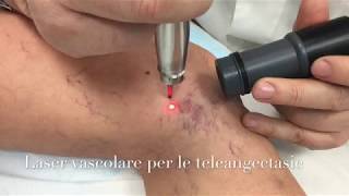 Laser vascolare per i capillari delle gambe [upl. by Alesram622]