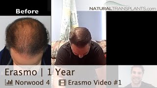 Norwood 4Hair Transplant 1Year Results  Before and After  Dr Matt Huebner Erasmo [upl. by Sacrod]