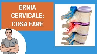 Ernia cervicale guida ai consigli e agli esercizi [upl. by Adrial765]