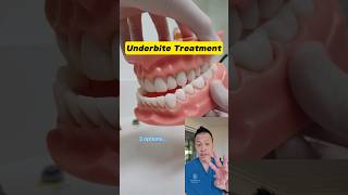 Transform Your Smile 3 Underbite Correction Options You Need to Know shorts dentallan [upl. by Beker]