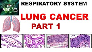 LUNG CANCER Part 1 Epidemiology Etiopathogenesis Precursor lesions amp Classification [upl. by Gussie]