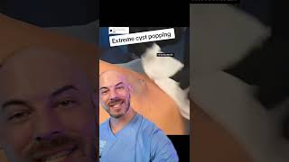 These extreme cyst pops might leave you feeling queasy 🤢doctor satisfying viral trending [upl. by Selden498]